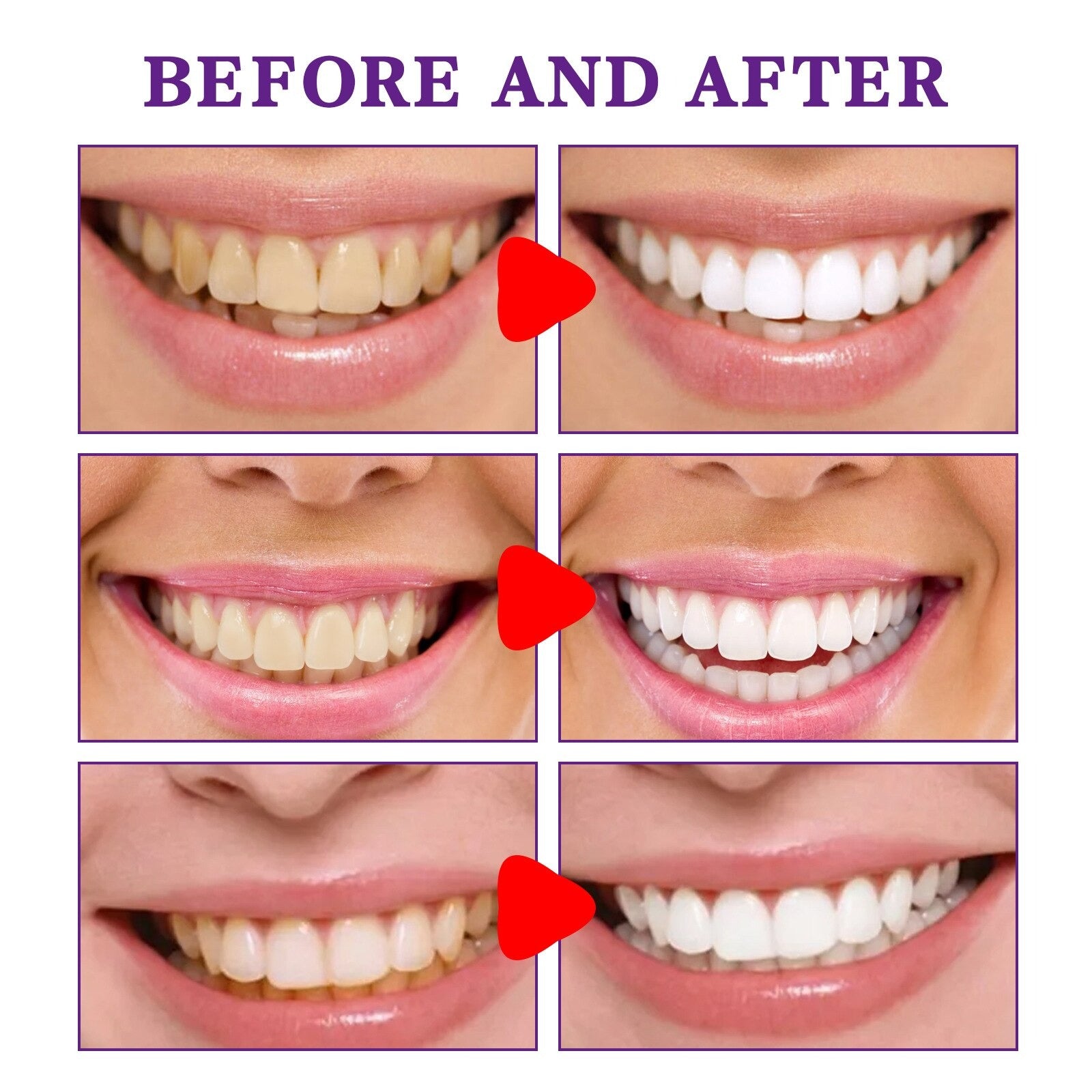 Smiley™ - Intensive Entfernung von Verfärbungen Zahnweiß-Zahnpasta (1+1 FREE)